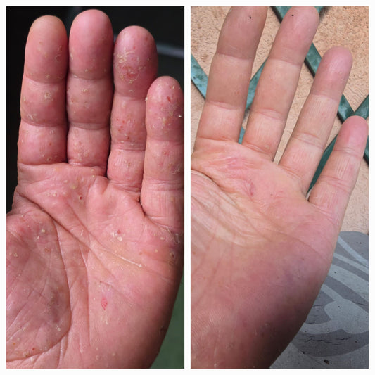 Nettoyant Apaisant - Acné, Eczéma, Psiorasis