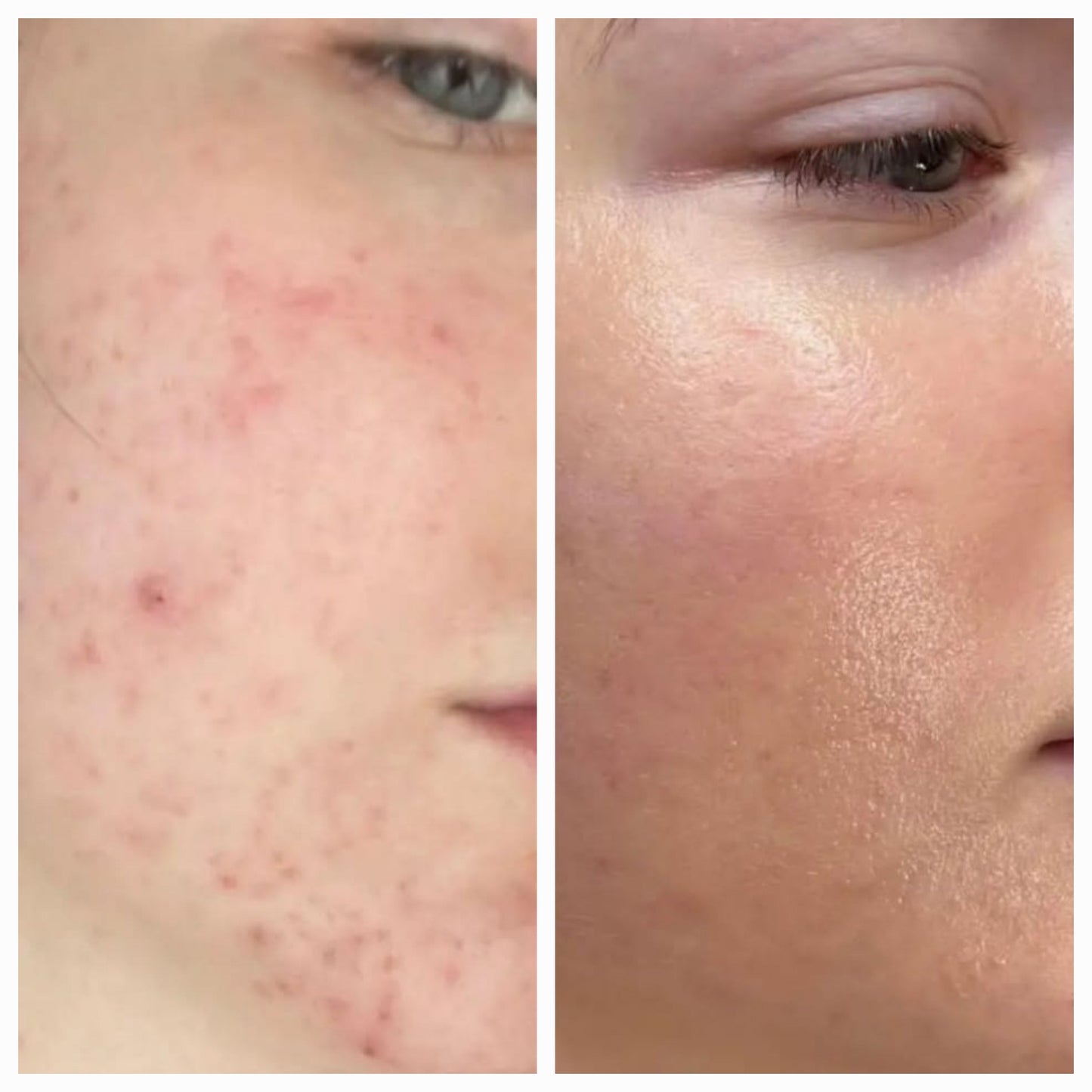 Nettoyant Apaisant - Acné, Eczéma, Psiorasis